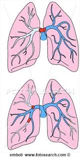 pulmonaryembolus