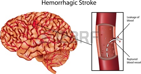 hemorrhagic-stroke