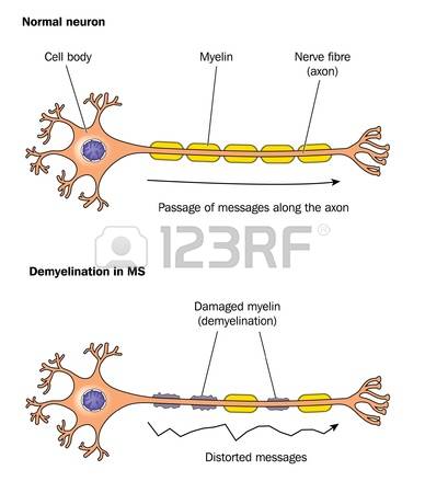 Multiplesclerosis