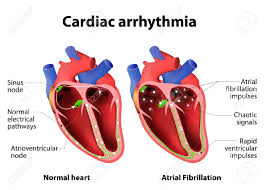 Afib